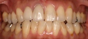 　錦織②-4　下ホワイトニング後